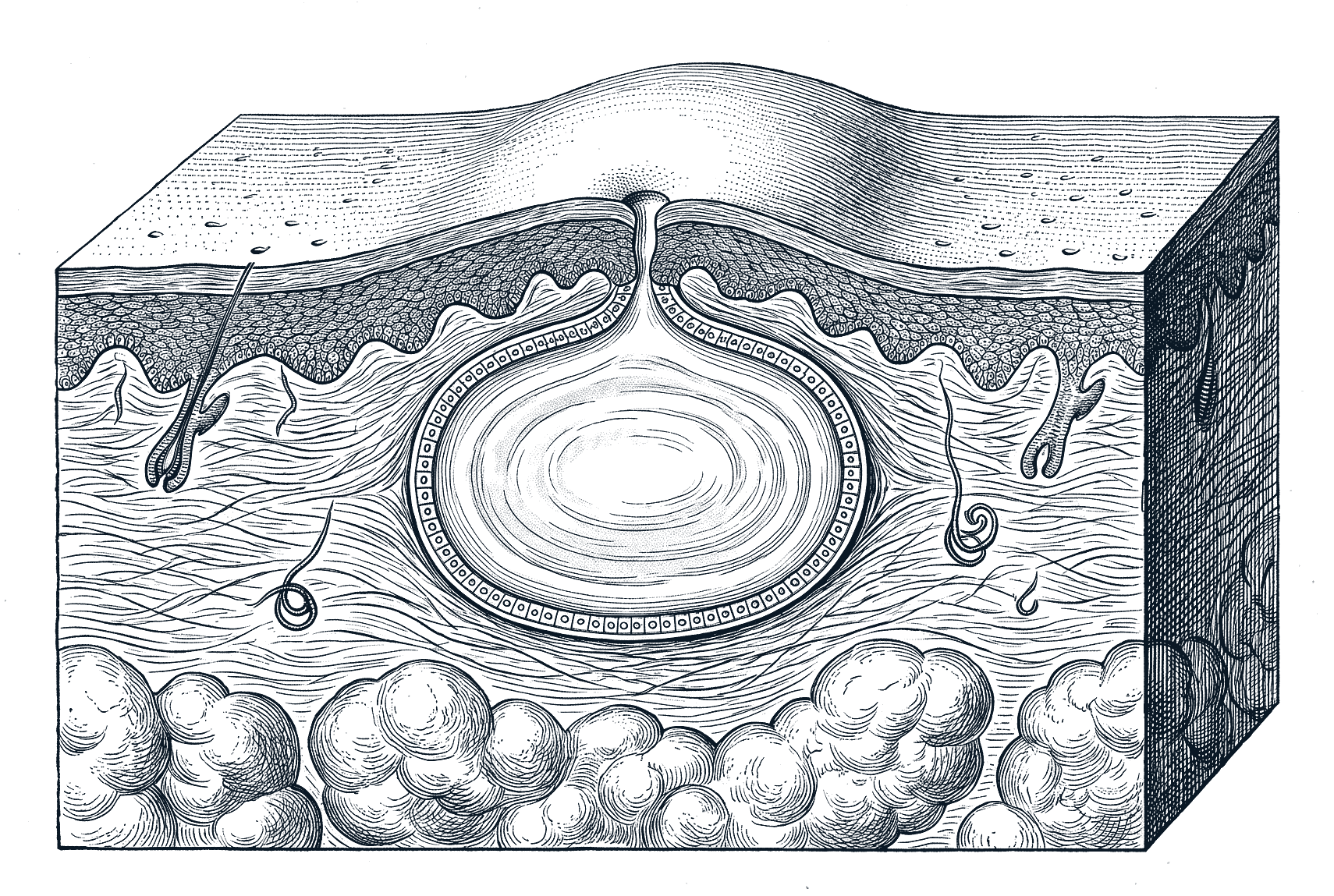 Engraved cross-section of skin with a rounded epidermoid cyst in the dermis: a thin sac wall filled with layered keratin, a tiny pore on the skin surface above, and fat below