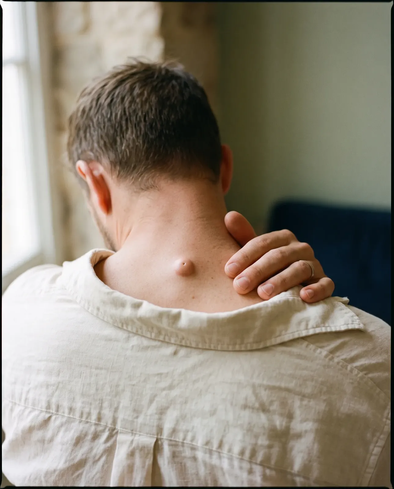 A man seen from behind, his hand on his shoulder beside a smooth, dome-shaped cyst below the back of his neck
