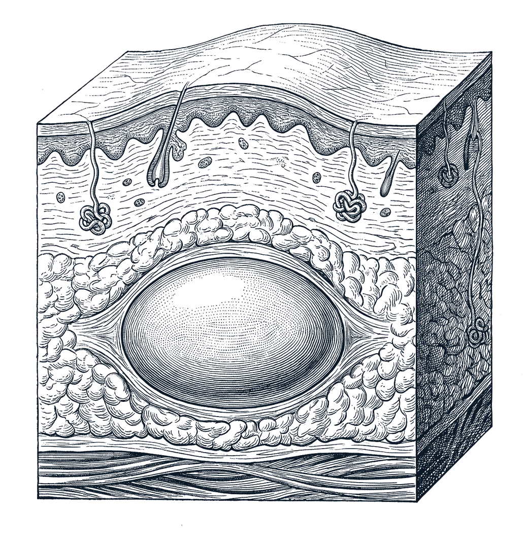 Engraved cross-section of skin: a smooth, encapsulated lipoma sits in the fat layer beneath the skin, above the muscle, gently raising the surface