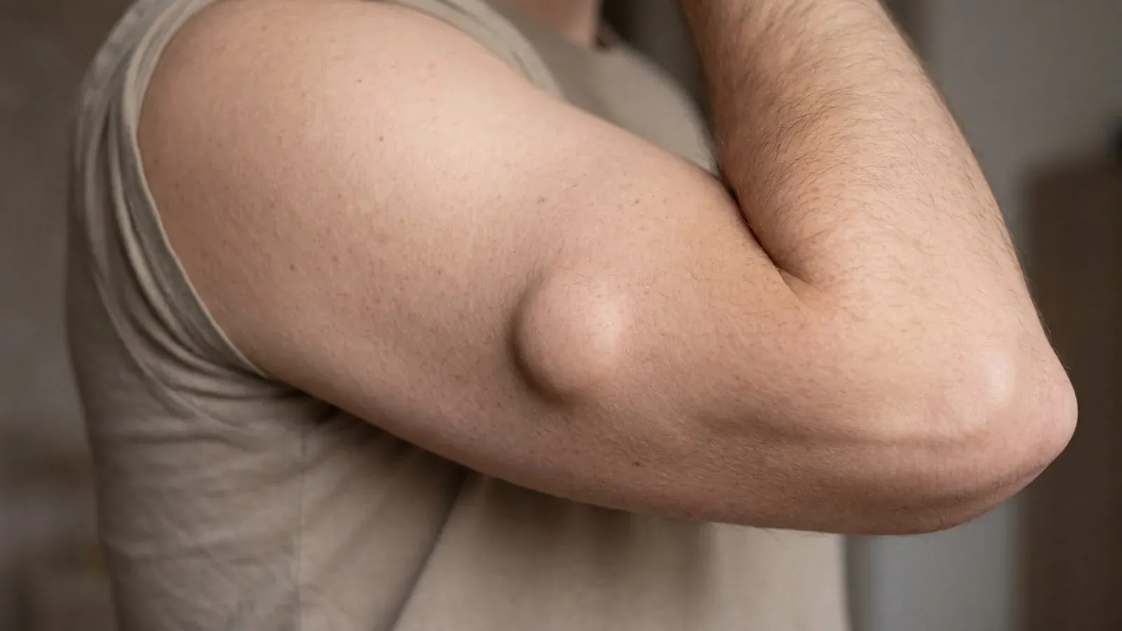 A typical lipoma on the upper arm, a soft, mobile lump under the skin
