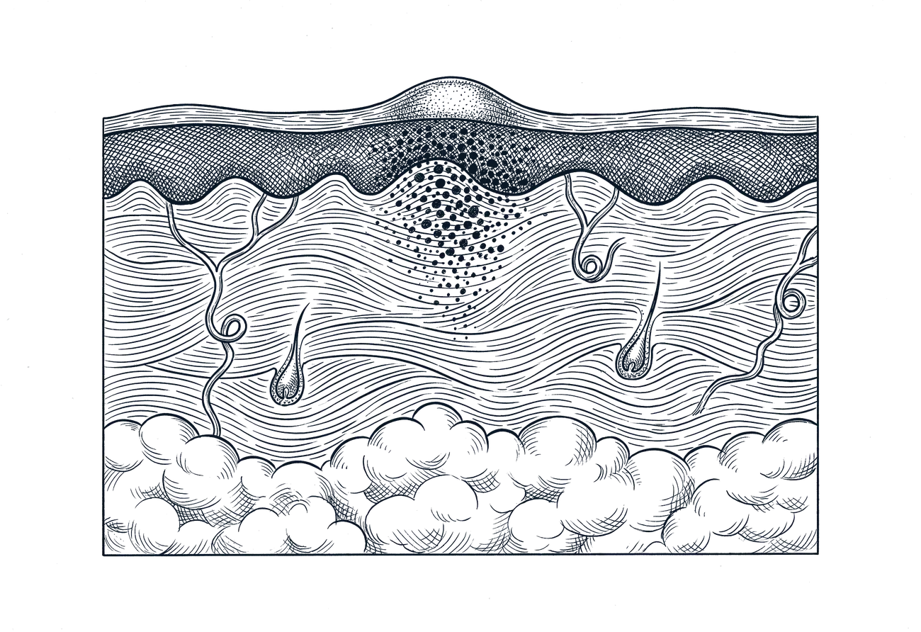Engraved schematic cross-section of skin with a small raised mole, showing the outer skin layer, the deeper dermis and the fat beneath