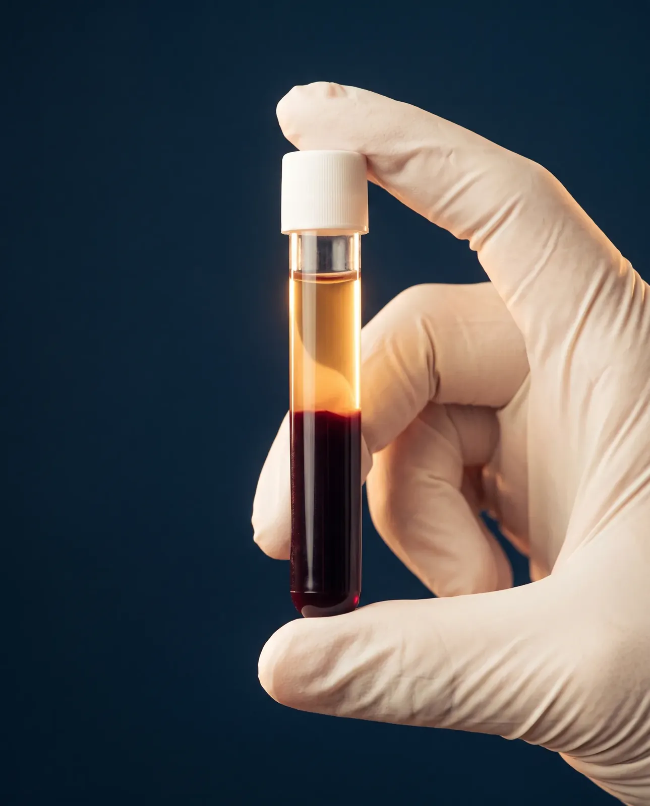 A gloved hand holding a spun blood tube: a clear golden layer above deep red