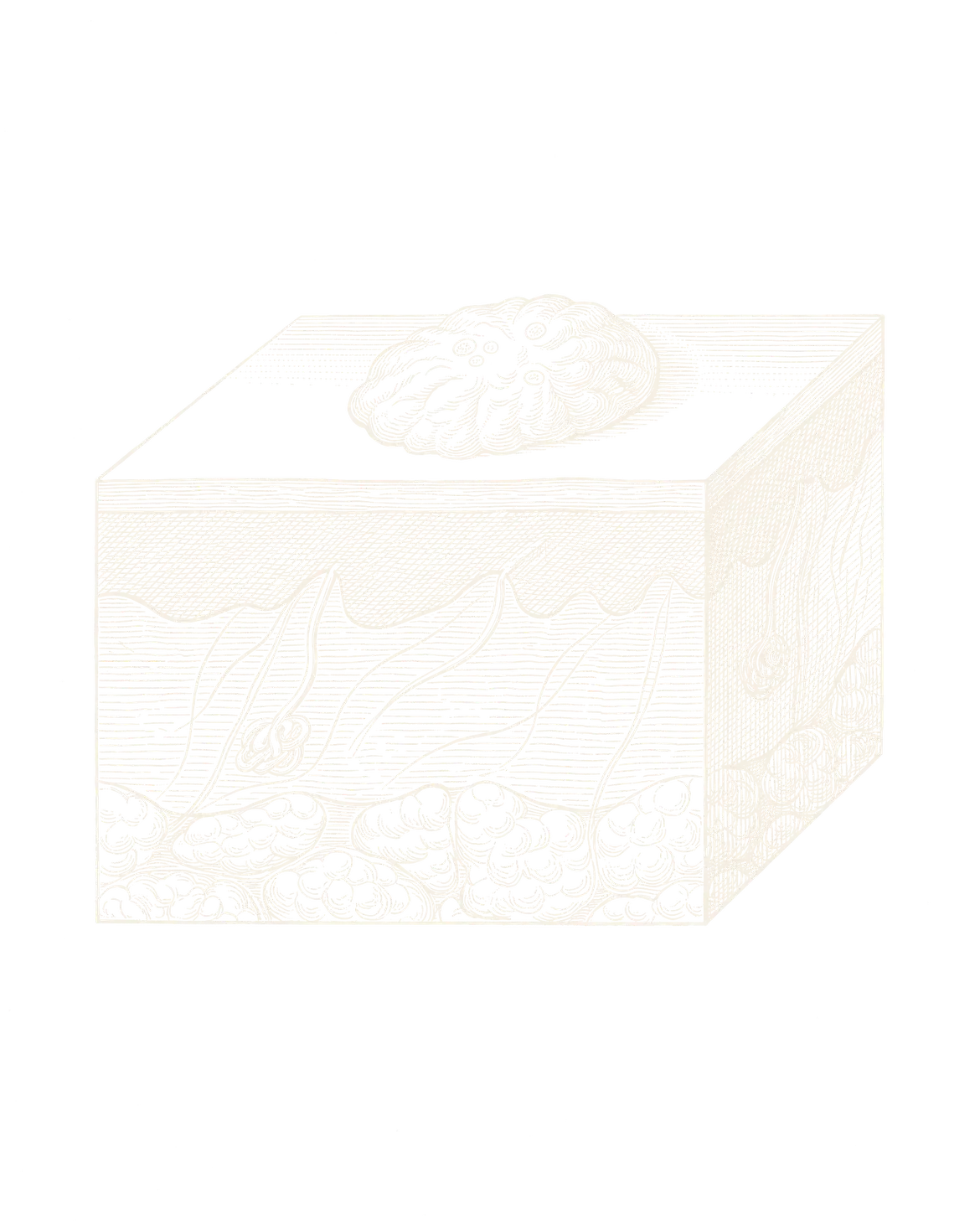 Engraved cross-section of skin with a seborrhoeic keratosis sitting on the surface, like a drop of wax
