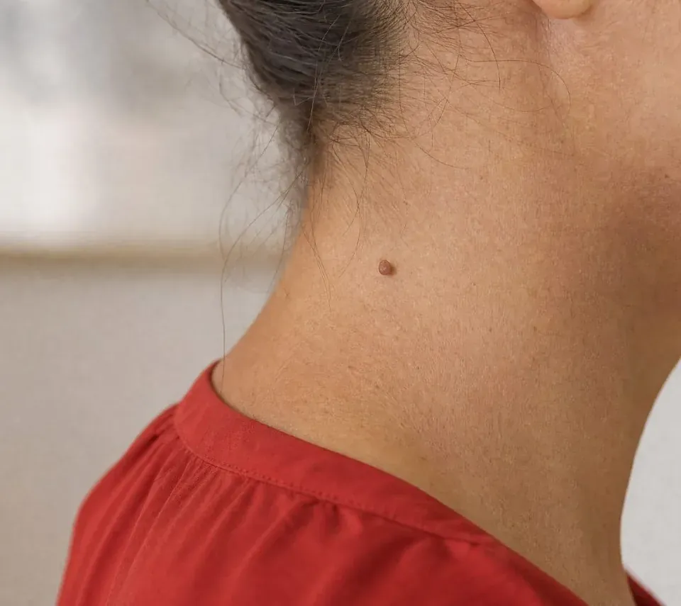 A small skin tag on the neck, soft and attached by a thin pedicle