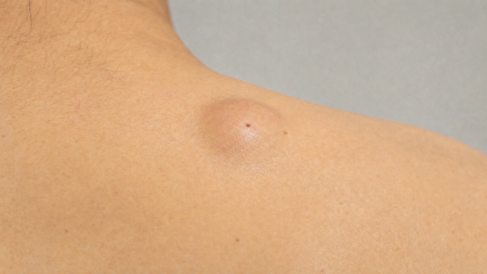Cyst Removal Recovery: Scarring, Healing and Aftercare