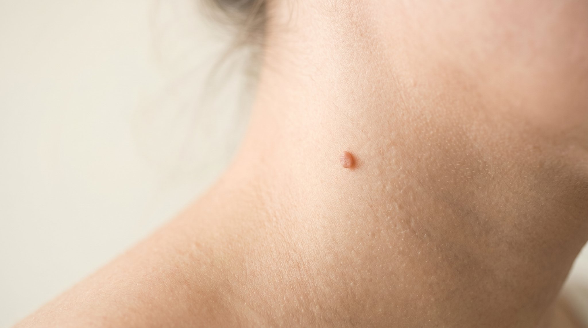 Skin Tag Removal