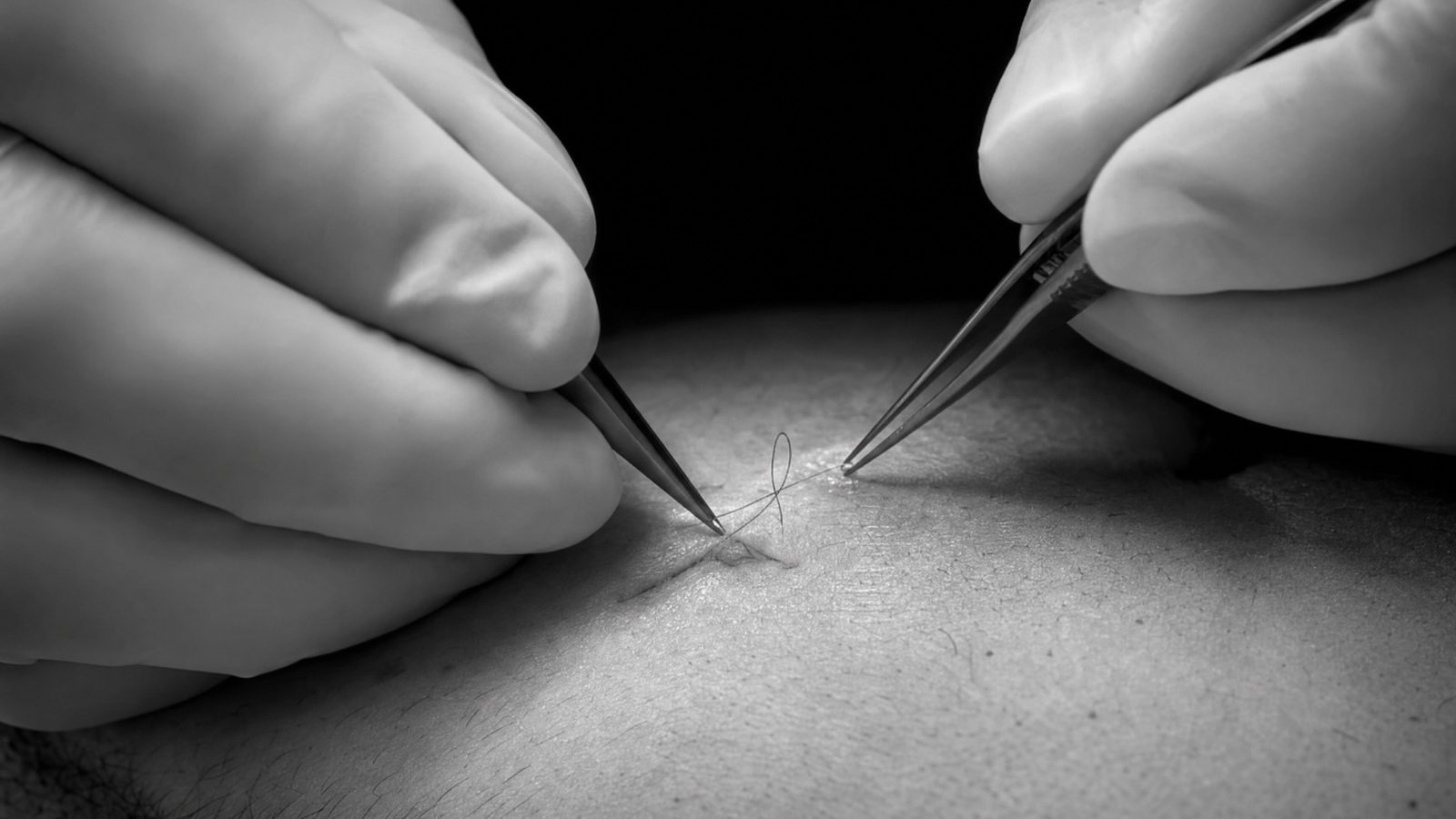 Gloved hands removing sutures from a patient's skin