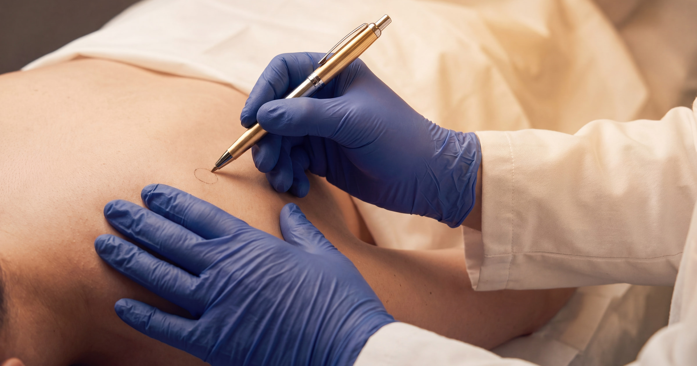 Cyst Removal in Wirral · Skin & Joint Injection Clinic