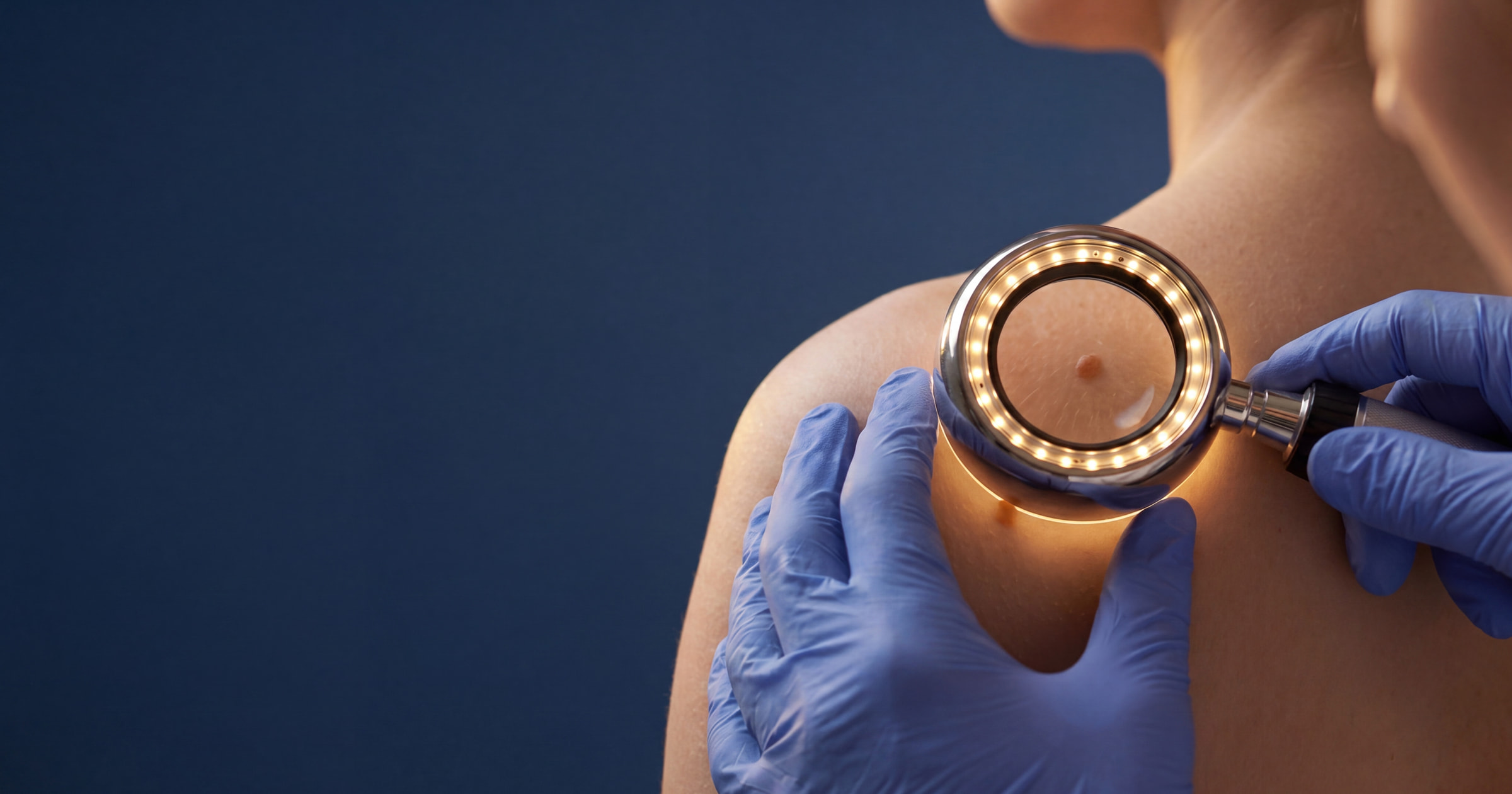 Mole Removal in Wirral · Skin & Joint Injection Clinic