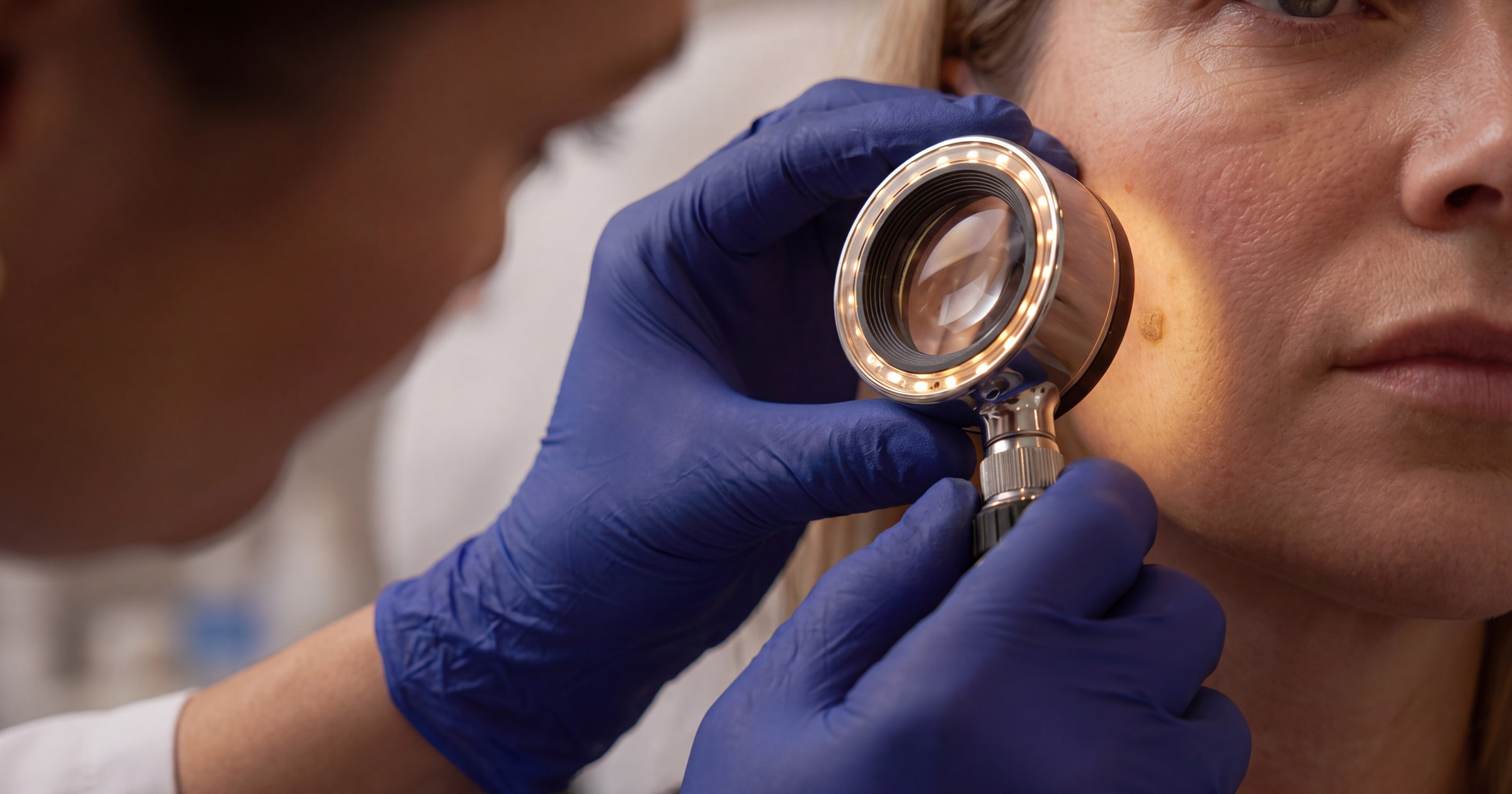 Seborrhoeic Keratosis Removal in Wirral · Skin & Joint Injection Clinic