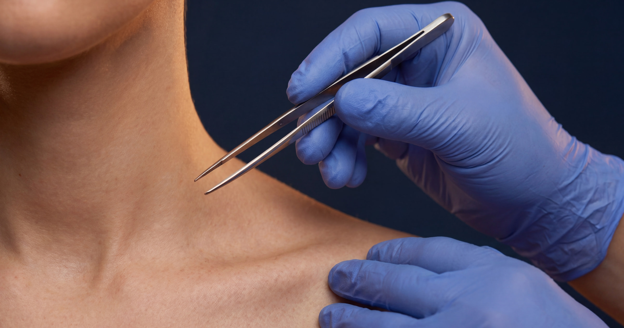 Skin Tag Removal in Wirral · Skin & Joint Injection Clinic