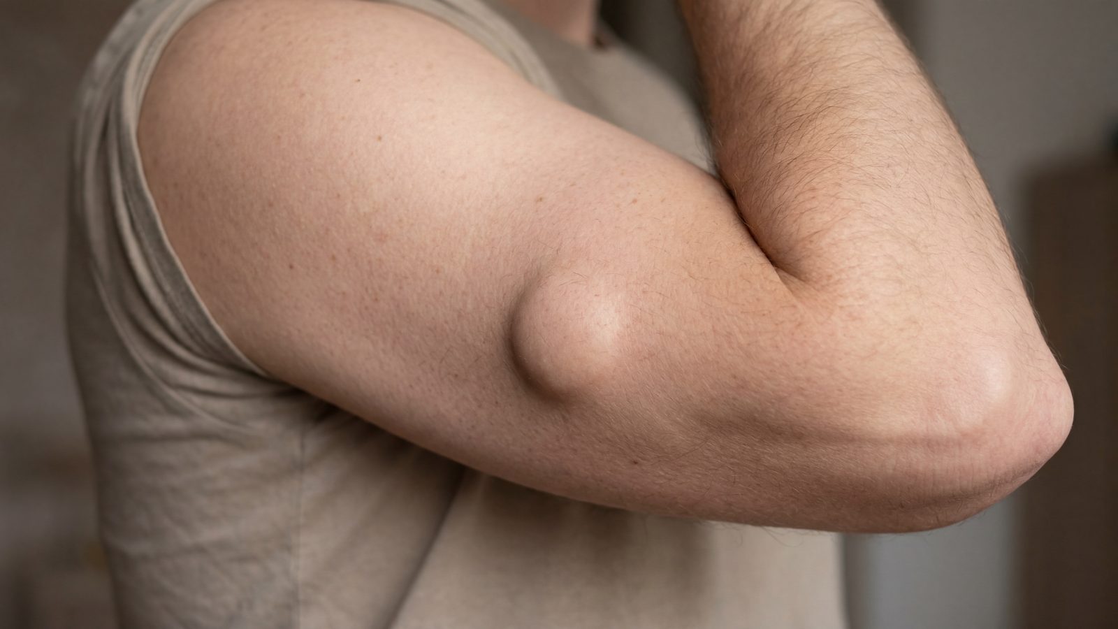 A typical lipoma on the upper arm, a soft, mobile lump under the skin