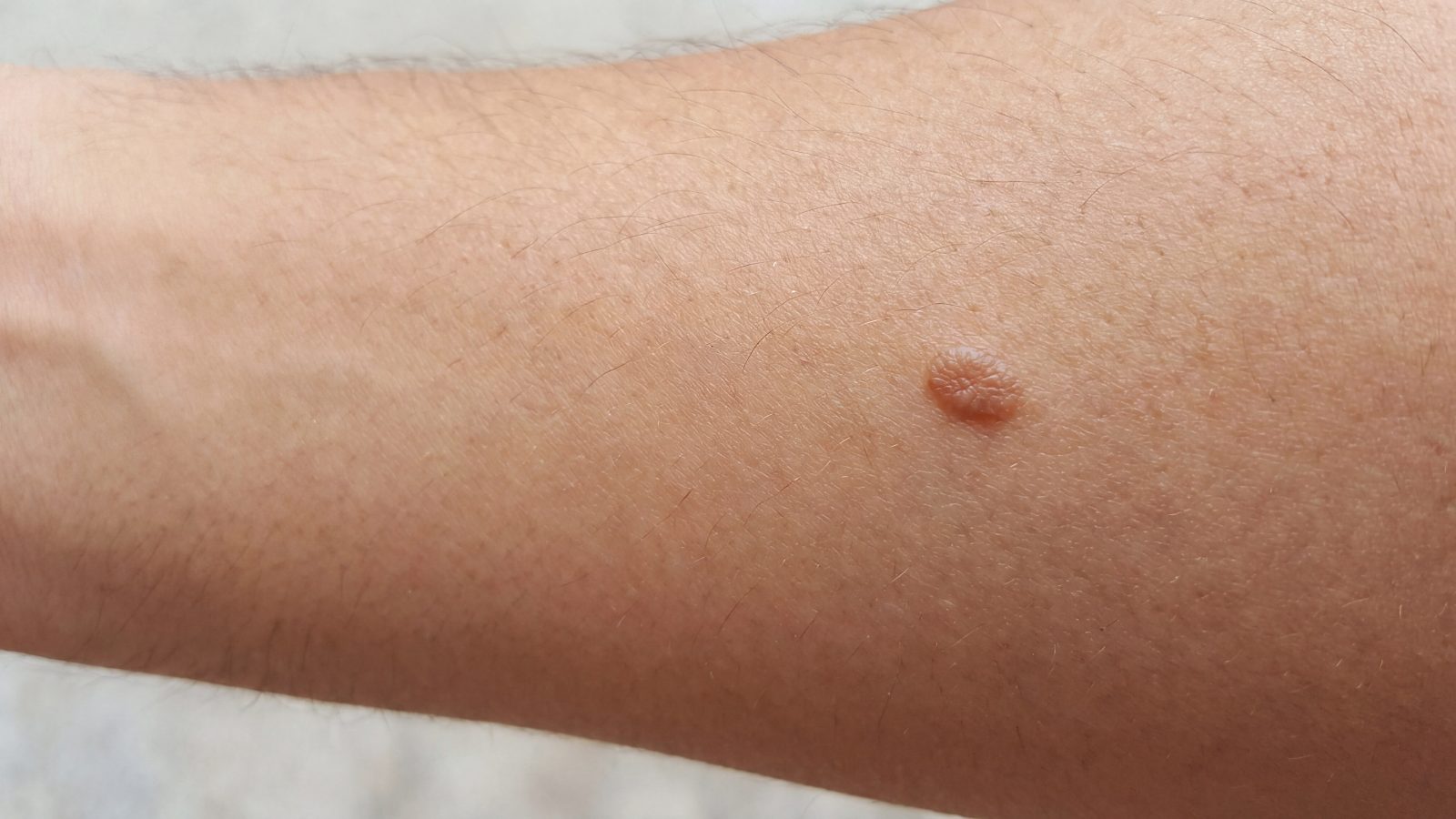 A typical benign mole on the arm, evenly pigmented with a well-defined edge