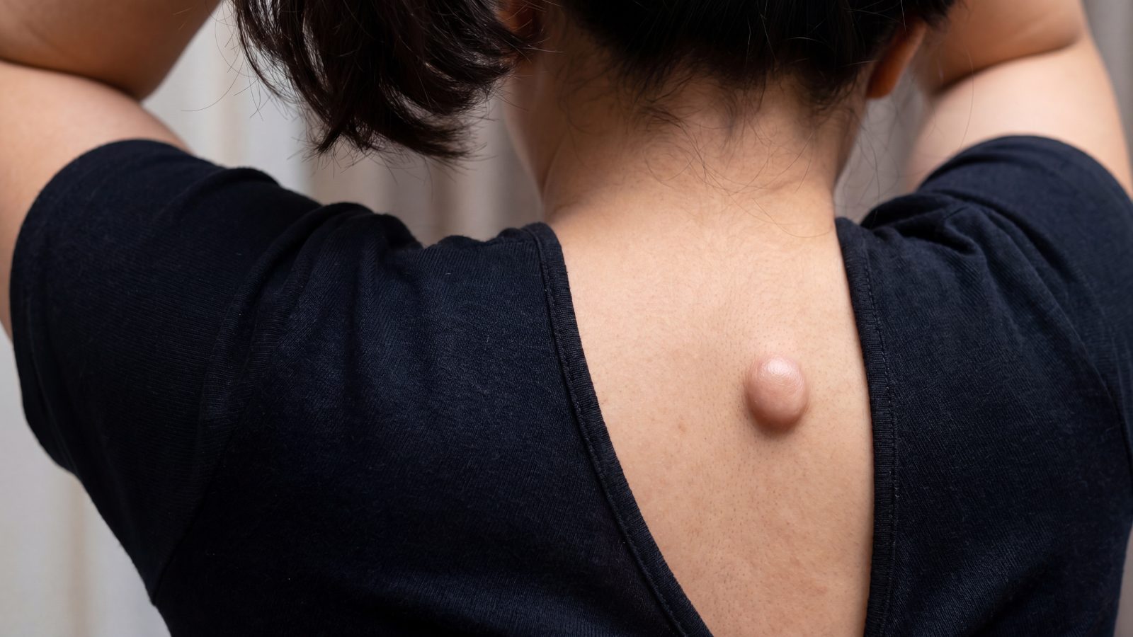 Close-up of an epidermoid (sebaceous) cyst on the skin