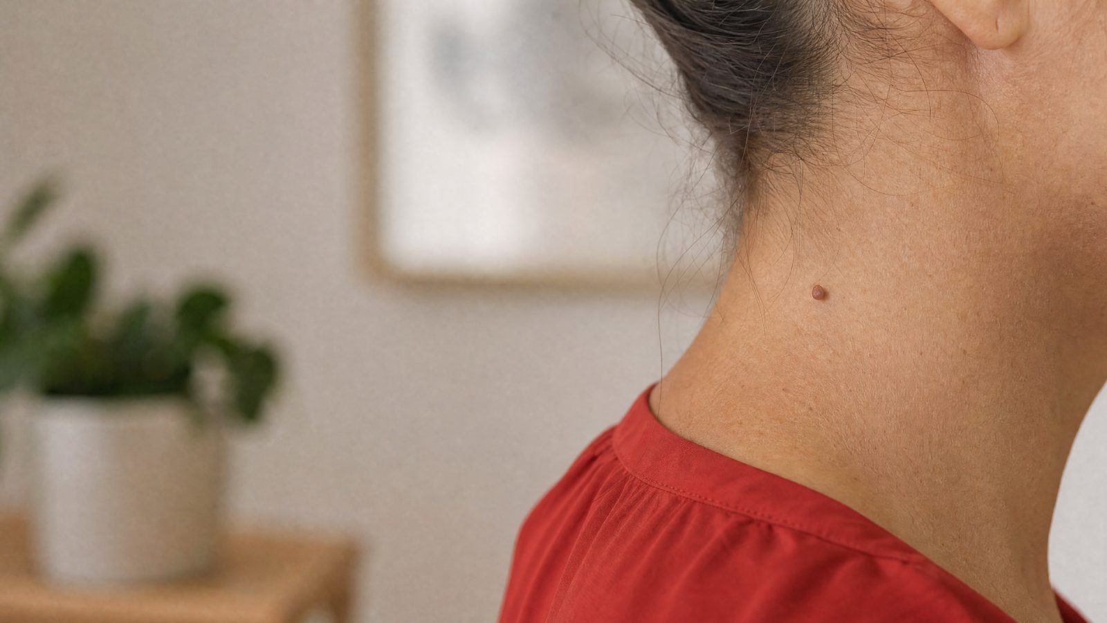 A small skin tag on the neck, soft and attached by a thin pedicle